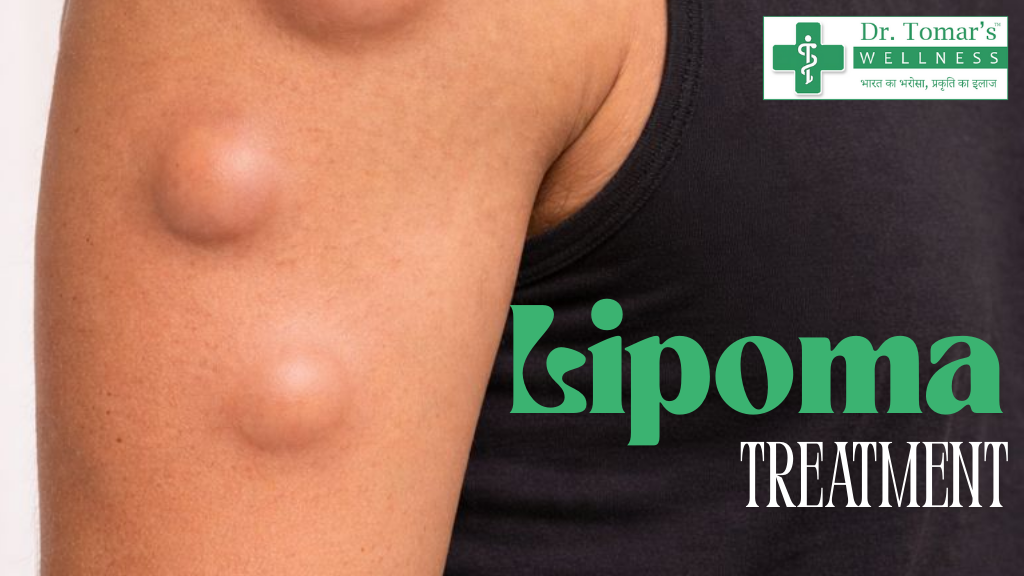Best Lipoma Treatment in Surat